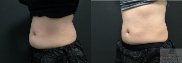 Before & After Coolsculpting Case 55 45 Degree Angle View in Rochester, NY