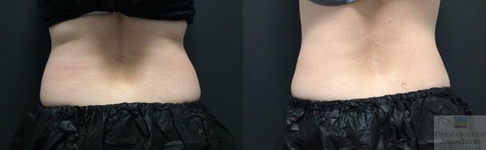 Before & After Coolsculpting Case 55 Back View in Rochester, NY