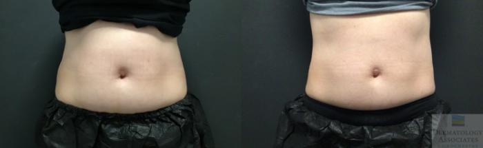 Before & After Coolsculpting Case 55 Front View in Rochester, NY