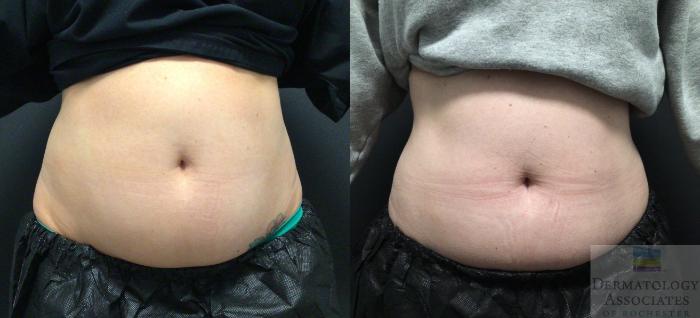 Before & After Coolsculpting Case 74 Front View in Rochester, NY