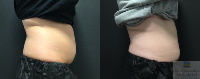 Before & After Coolsculpting Case 74 Right Side View in Rochester, NY