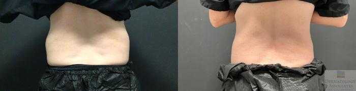 Before & After Coolsculpting Case 81 Back View in Rochester, NY