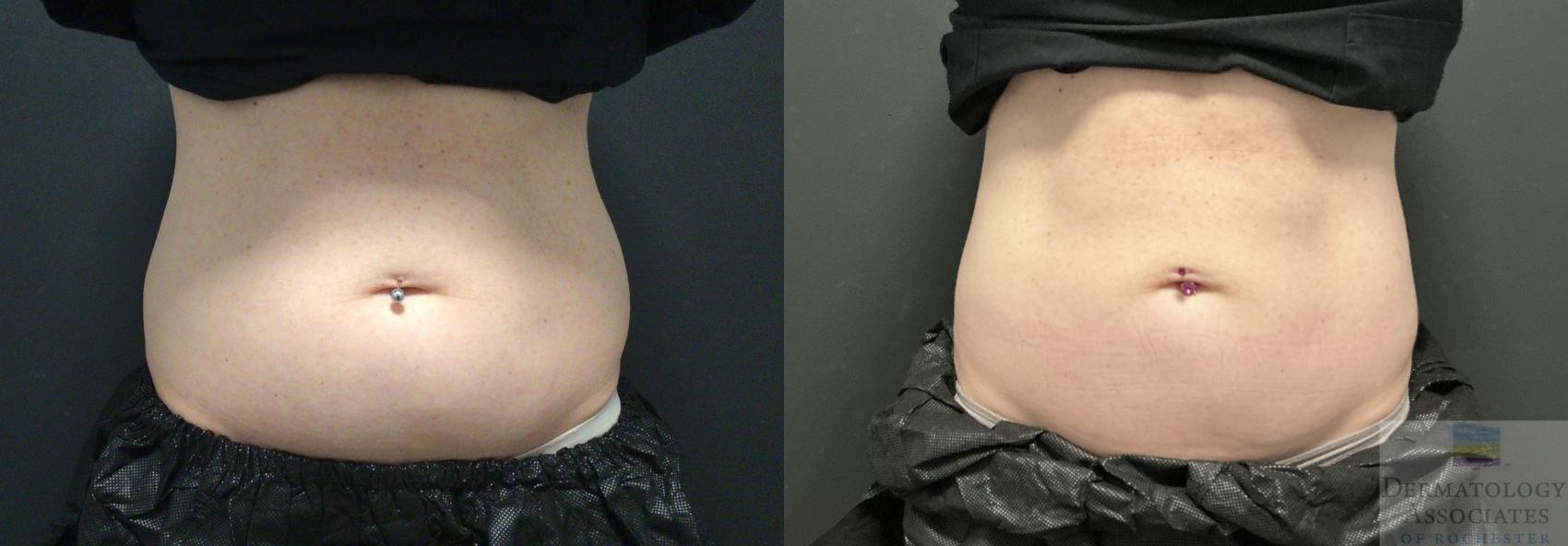 Before & After Coolsculpting Case 81 Front View in Rochester, NY