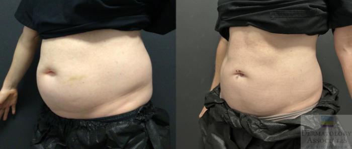 Before & After Coolsculpting Case 81 Left Side View in Rochester, NY