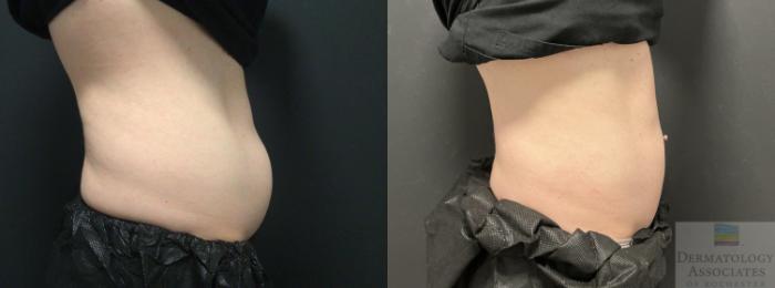 Before & After Coolsculpting Case 81 Right Side View in Rochester, NY