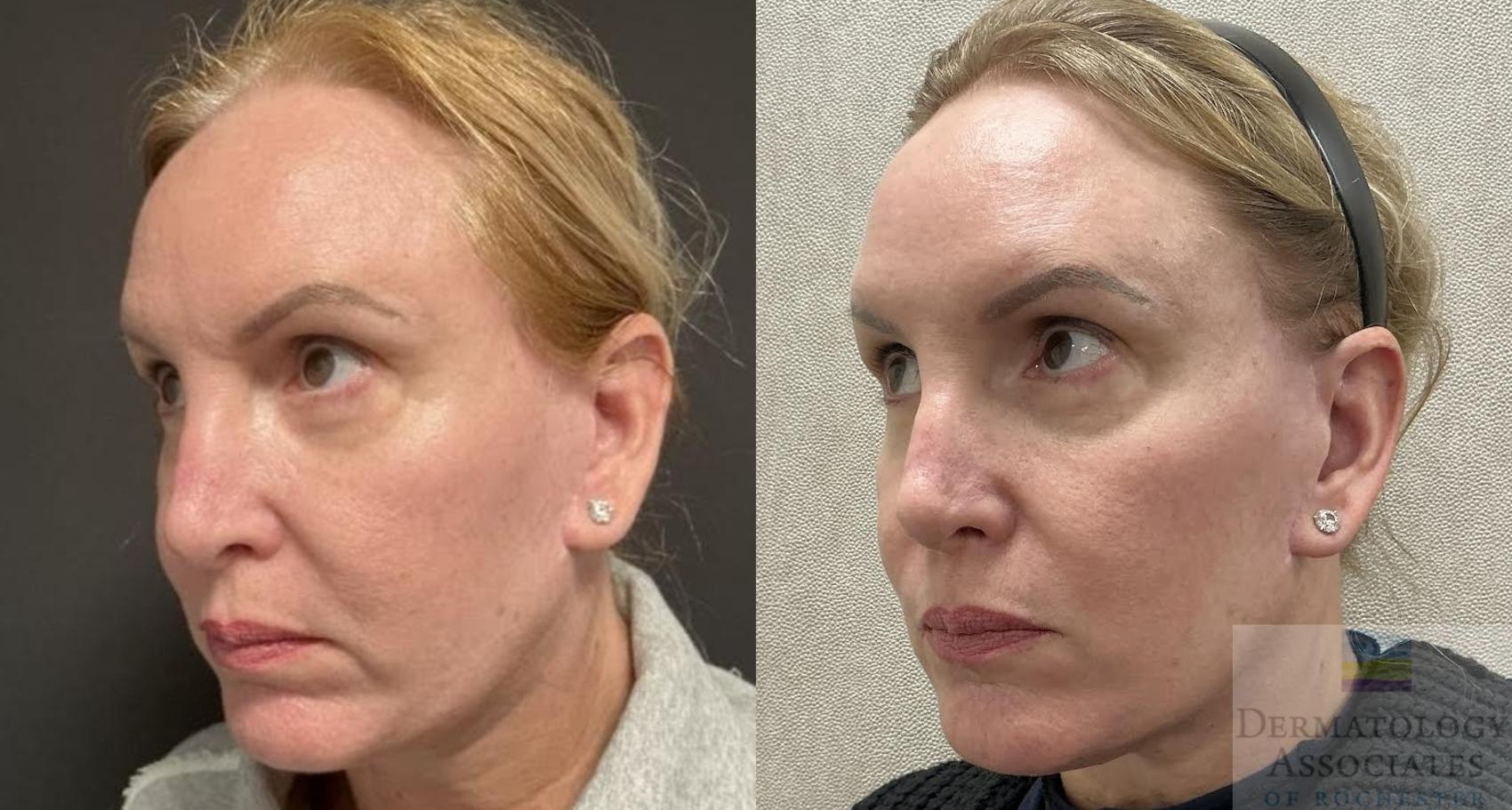 Before & After Dermal Fillers Case 111 Left Angle View in Rochester, NY