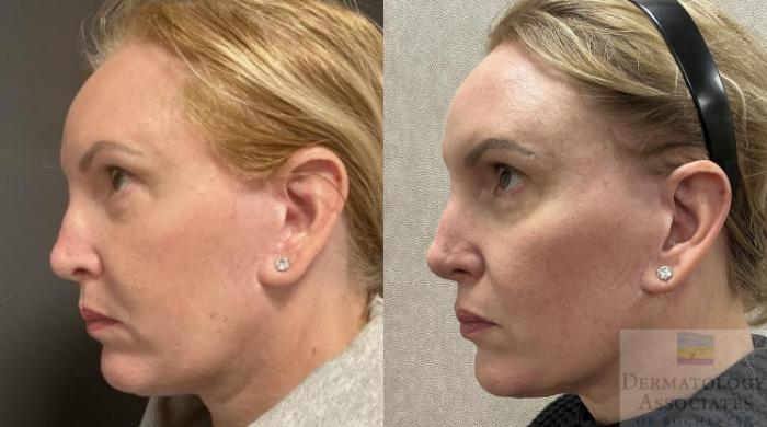 Before & After Dermal Fillers Case 111 Left Side View in Rochester, NY