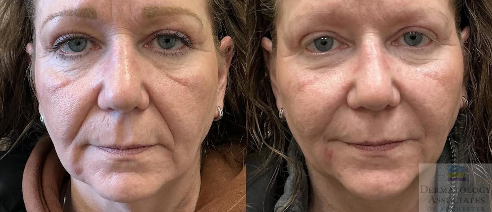 Before & After Dermal Fillers Case 112 Front View in Rochester, NY