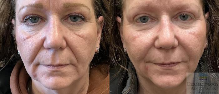 Before & After Dermal Fillers Case 112 Front View in Rochester, NY