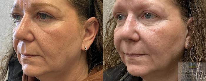 Before & After Dermal Fillers Case 112 Left Angle View in Rochester, NY