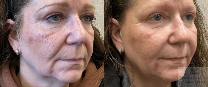 Before & After Dermal Fillers Case 112 Right Side Angle View in Rochester, NY
