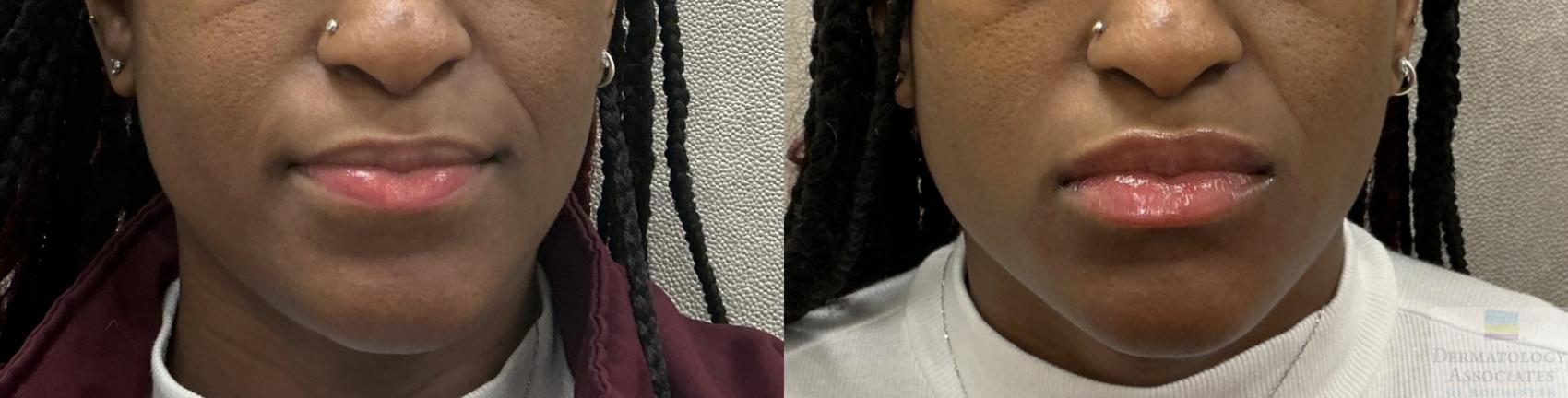 Before & After Dermal Fillers Case 117 Front View in Rochester, NY