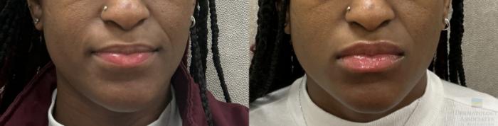 Before & After Dermal Fillers Case 117 Front View in Rochester, NY