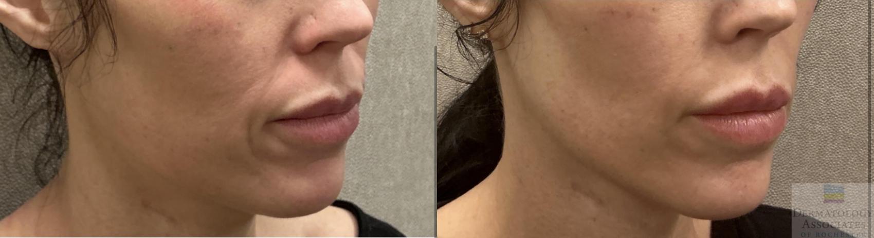 Before & After Dermal Fillers Case 125 Angle View in Rochester, NY