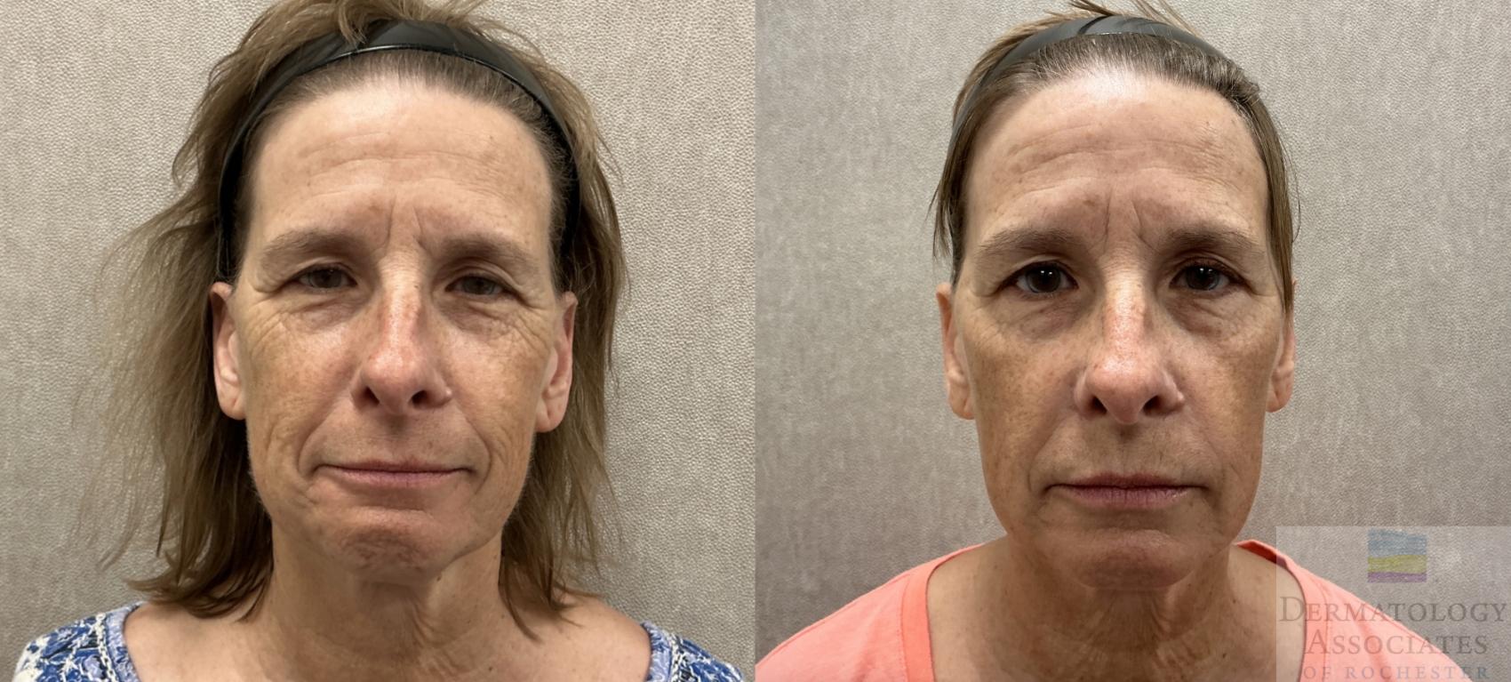 Before & After Dermal Fillers Case 128 Front View in Rochester, NY