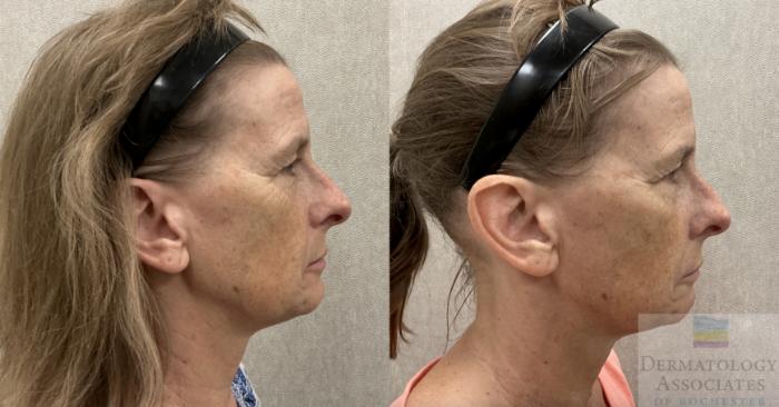 Before & After Dermal Fillers Case 128 Right Side View in Rochester, NY