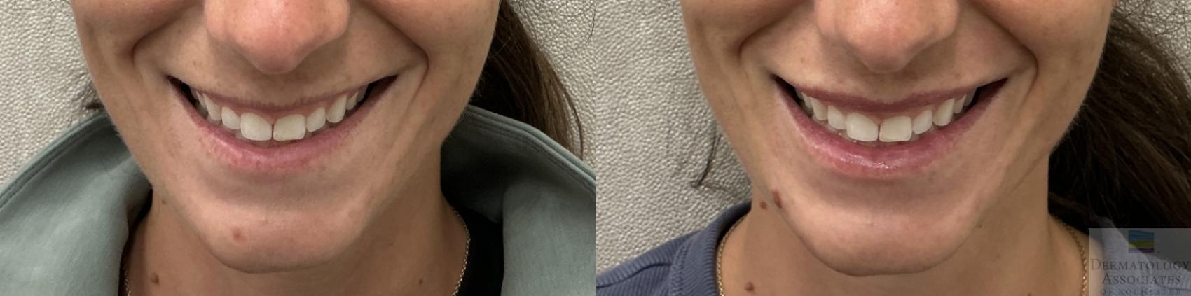 Before & After Dermal Fillers Case 138 Front View in Rochester, NY
