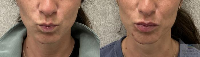Before & After Dermal Fillers Case 138 Front - Kiss Face View in Rochester, NY