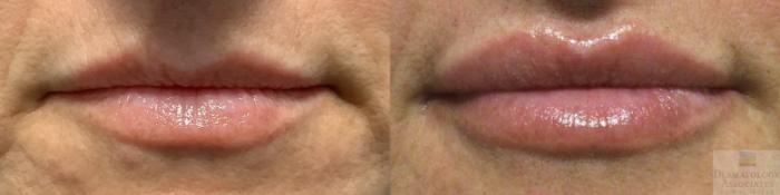Before & After Dermal Fillers Case 22 Front View in Rochester, NY