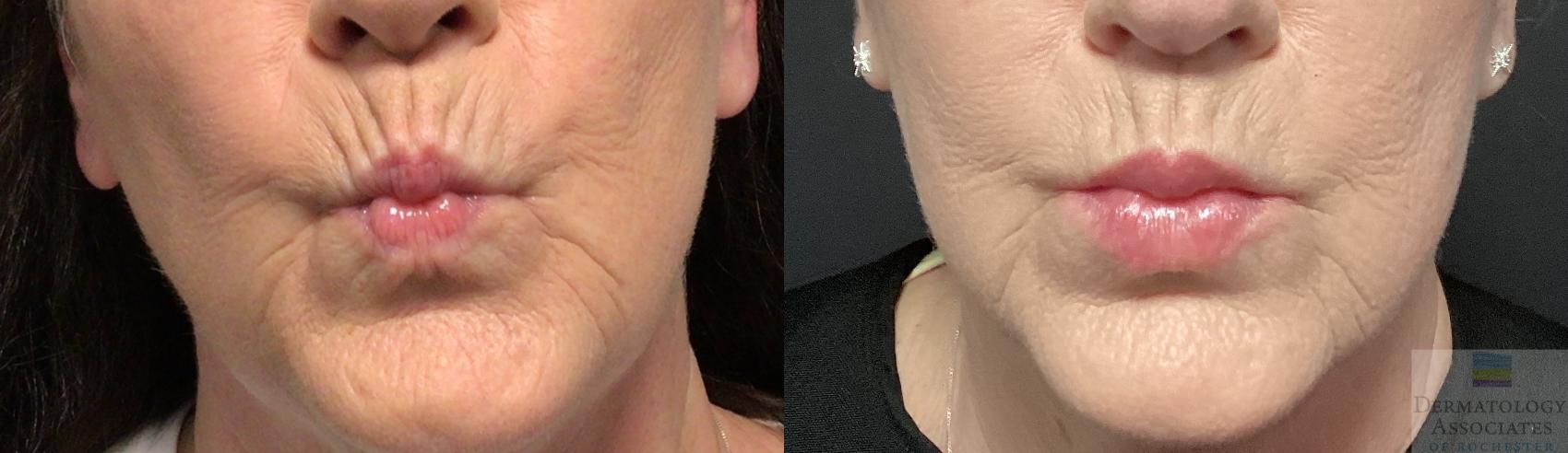 Before & After Dermal Fillers Case 35 Front View in Rochester, NY