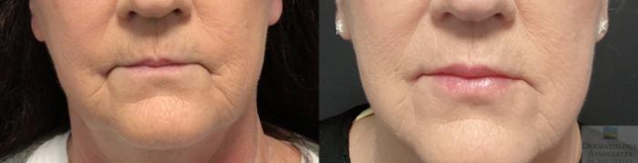 Before & After Dermal Fillers Case 35 Front- straight face View in Rochester, NY