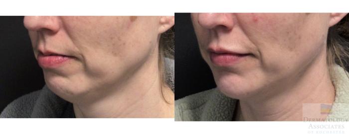 Before & After Dermal Fillers Case 37 45 Degree Angle View in Rochester, NY