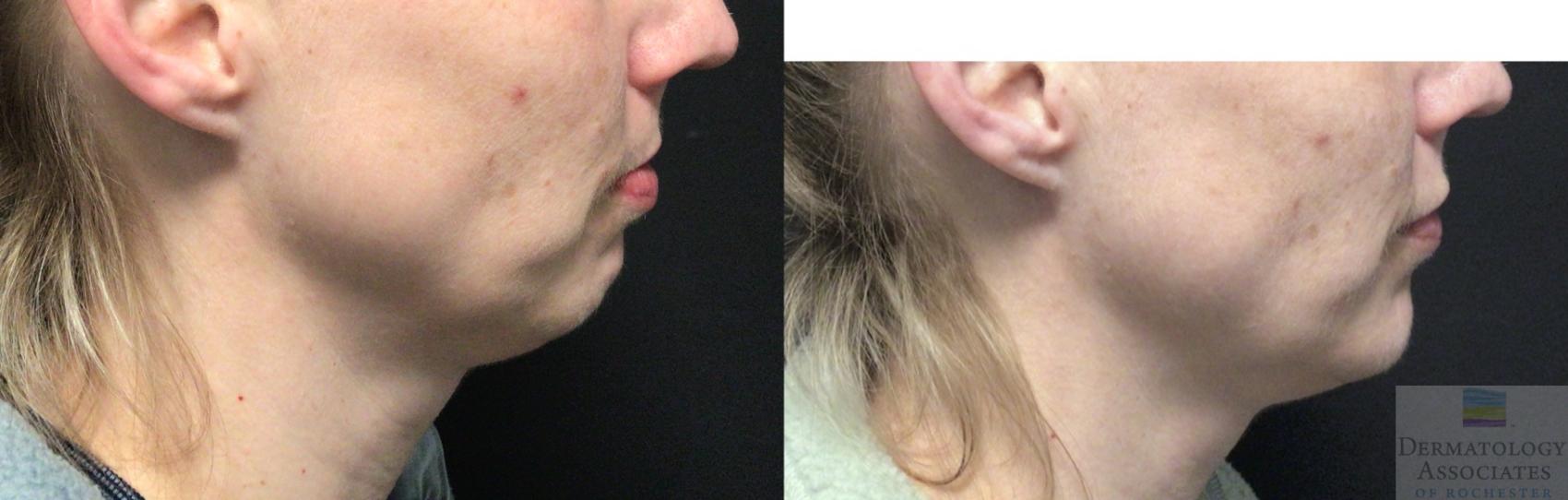 Before & After Dermal Fillers Case 37 90 Degree Angle View in Rochester, NY