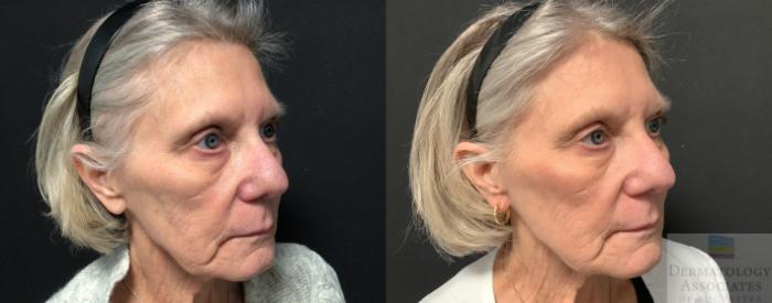 Before & After Dermal Fillers Case 43 45 Degree Angle View in Rochester, NY