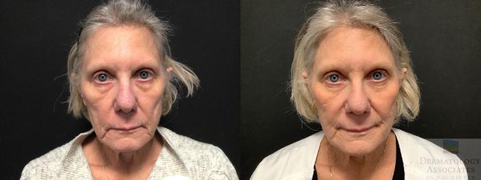 Before & After Dermal Fillers Case 43 Front View in Rochester, NY