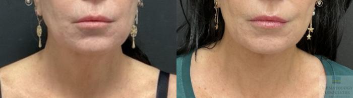 Before & After Facelift/Necklift Case 101 Front View in Rochester, NY