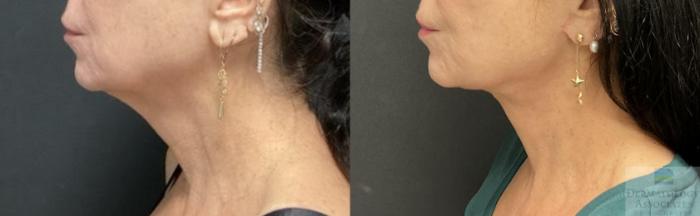 Before & After Facelift/Necklift Case 101 Left Side View in Rochester, NY