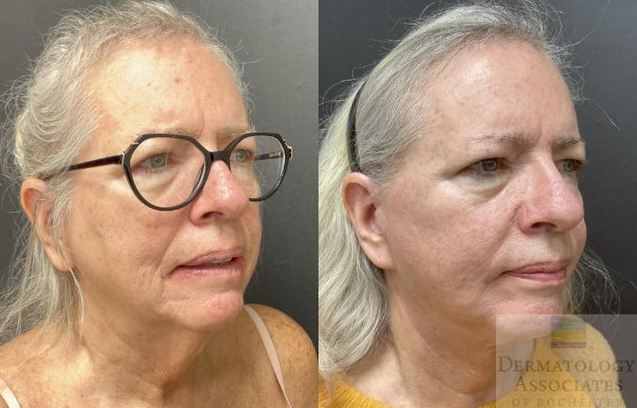 Before & After Facelift/Necklift Case 110 Right Side Angle View in Rochester, NY