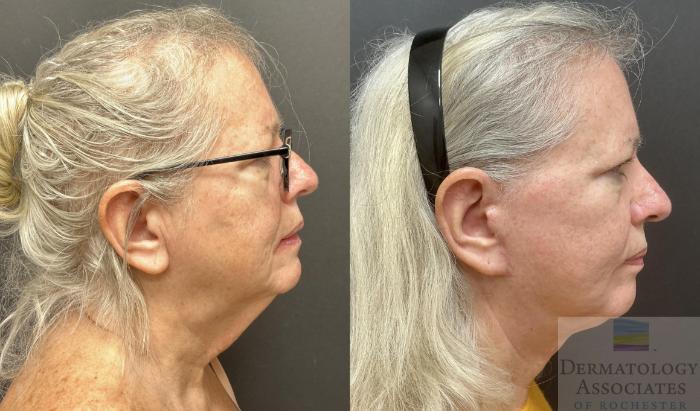 Before & After Facelift/Necklift Case 110 Right Side View in Rochester, NY