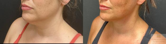 Before & After Facelift/Necklift Case 132 Angle View in Rochester, NY
