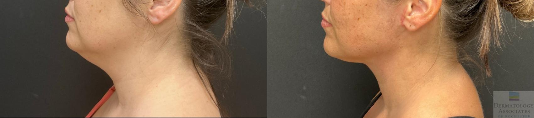 Before & After Facelift/Necklift Case 132 Left Side View in Rochester, NY