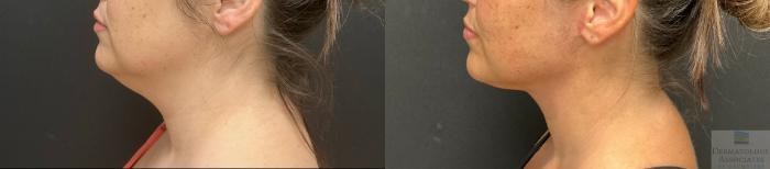 Before & After Facelift/Necklift Case 132 Left Side View in Rochester, NY