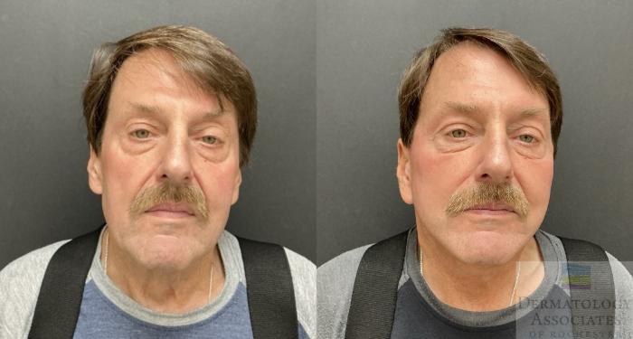 Before & After Facelift/Necklift Case 135 Front View in Rochester, NY