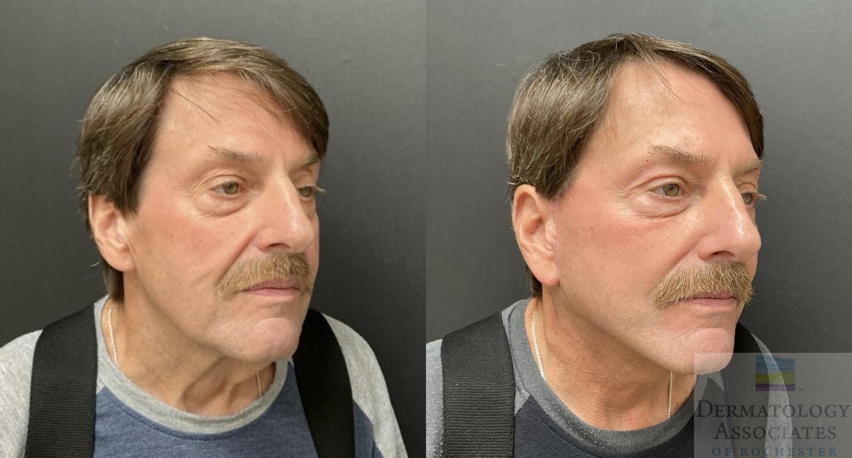 Before & After Facelift/Necklift Case 135 Right Side Angle View in Rochester, NY