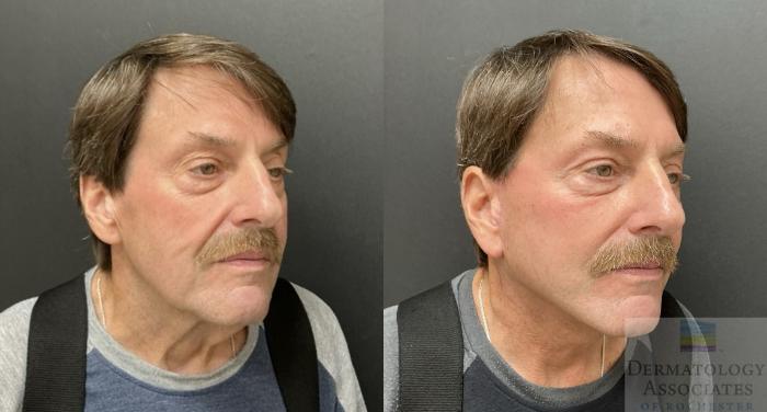 Before & After Facelift/Necklift Case 135 Right Side Angle View in Rochester, NY