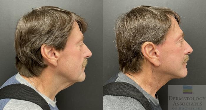 Before & After Facelift/Necklift Case 135 Right Side View in Rochester, NY