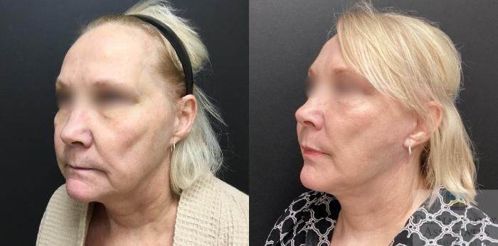 Before & After Facelift/Necklift Case 136 Angle View in Rochester, NY