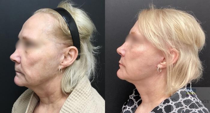 Before & After Facelift/Necklift Case 136 Left Side View in Rochester, NY