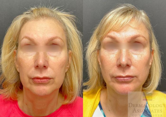 Before & After Facelift/Necklift Case 137 Front View in Rochester, NY