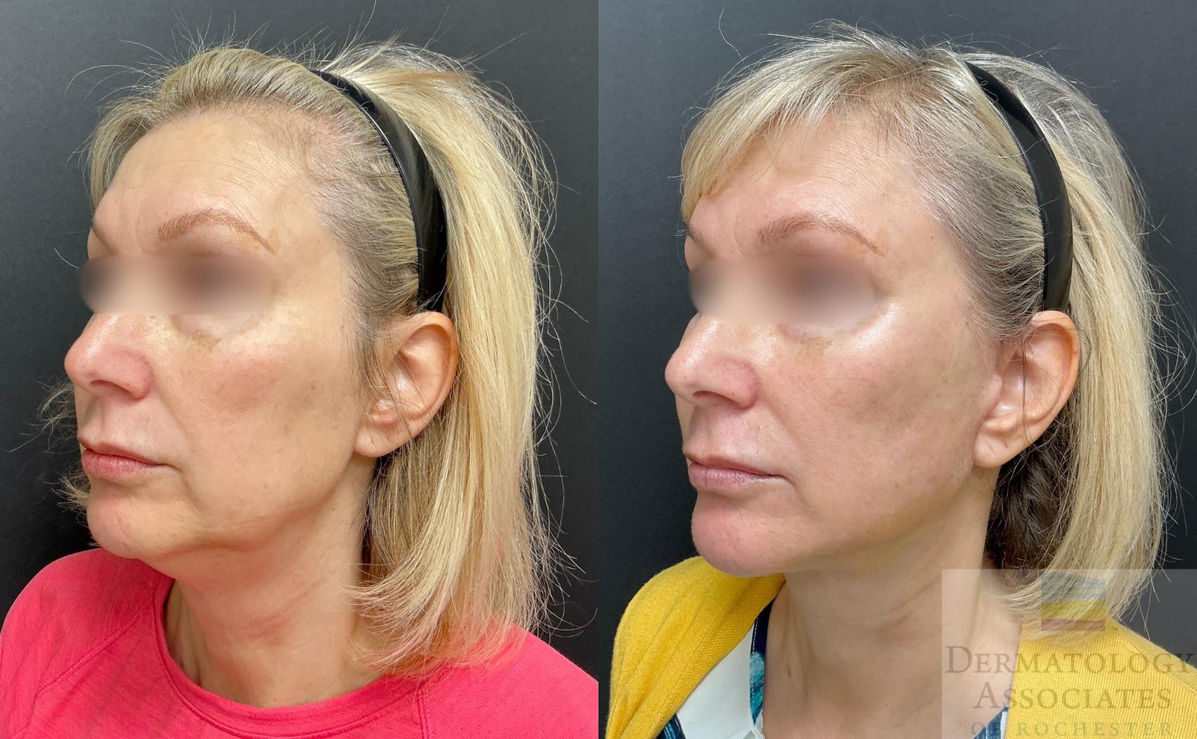 Before & After Facelift/Necklift Case 137 Left Oblique View in Rochester, NY