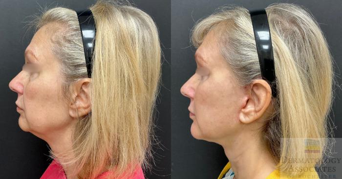 Before & After Facelift/Necklift Case 137 Left Side View in Rochester, NY