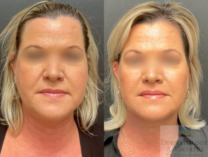 Before & After Facelift/Necklift Case 140 Front View in Rochester, NY