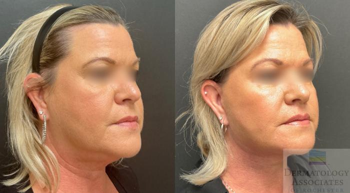 Before & After Facelift/Necklift Case 140 Right Oblique View in Rochester, NY