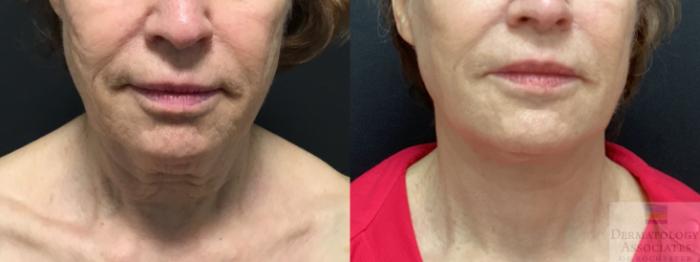 Before & After Facelift/Necklift Case 18 Front View in Rochester, NY