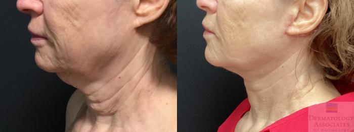 Before & After Facelift/Necklift Case 18 Left Side View in Rochester, NY