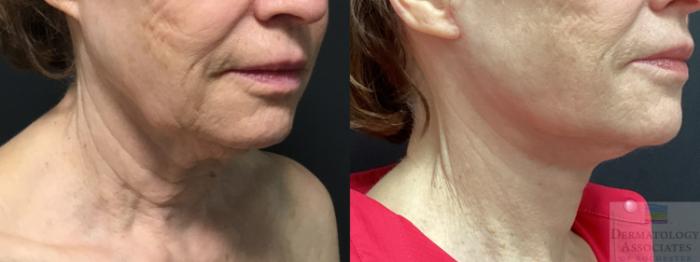 Before & After Facelift/Necklift Case 18 Right Oblique View in Rochester, NY